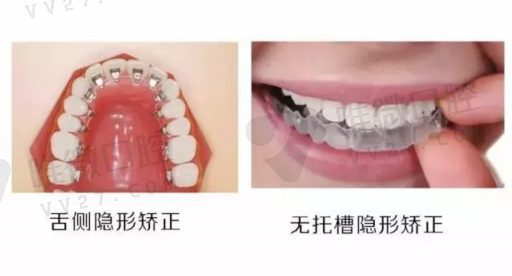 瓷贴面美白牙齿结果怎么样（牙齿的瓷贴面结果好吗）(图1)